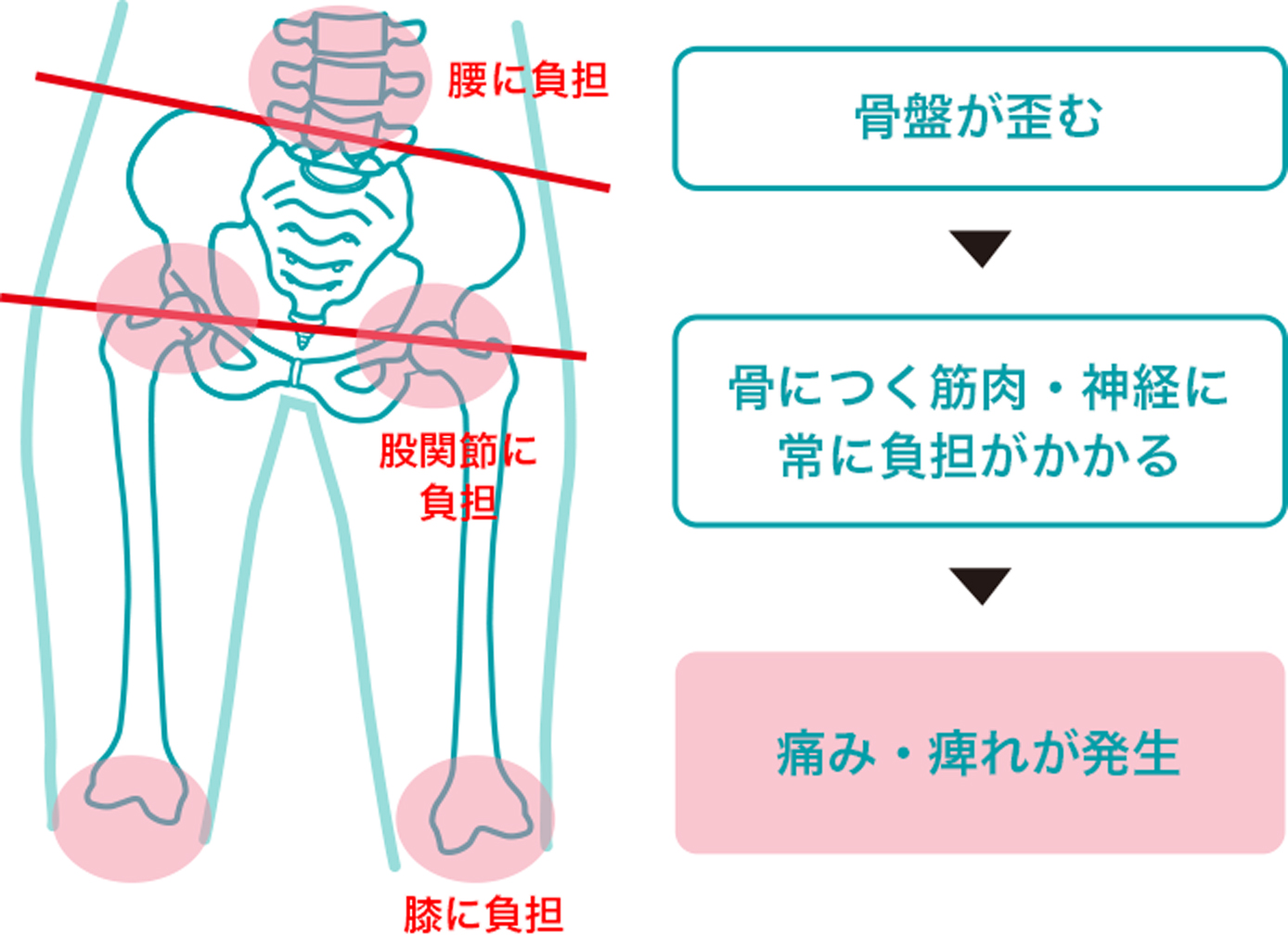 骨盤 が 痛い